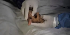 mpox-variola-dos-macacos-ferida